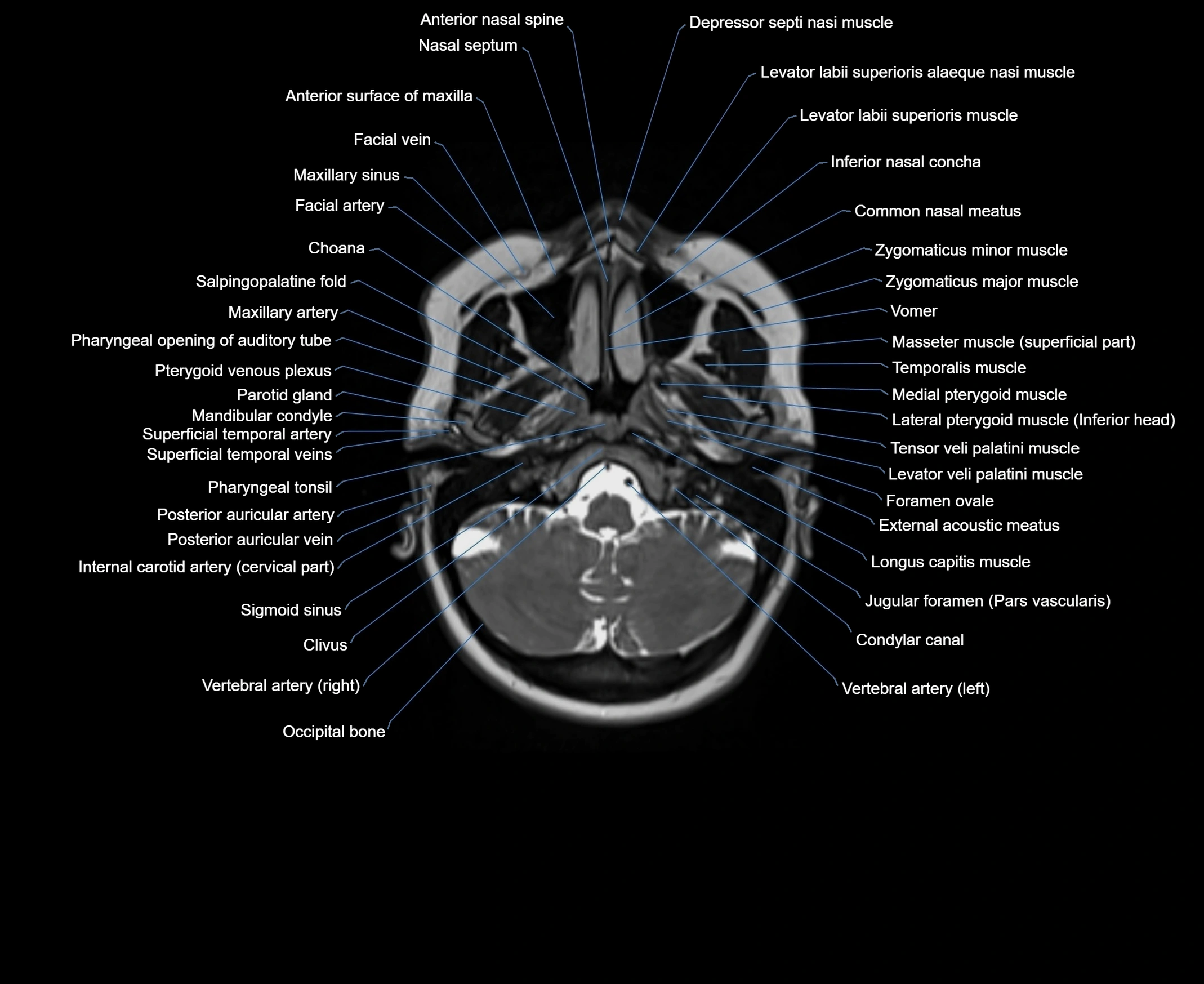 MRI Neck 3D labelled cross section anatomy axial 3t image-00001-00014.webp